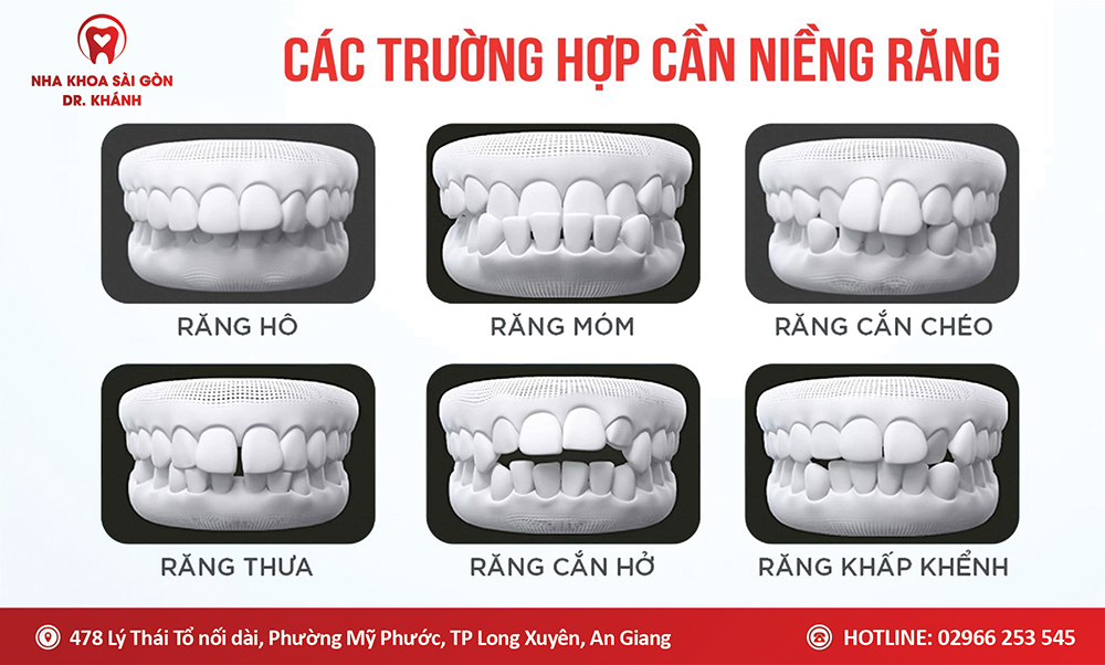 TOP 6 NHỮNG TRƯỜNG HỢP CẦN PHẢI NIỀNG RĂNG