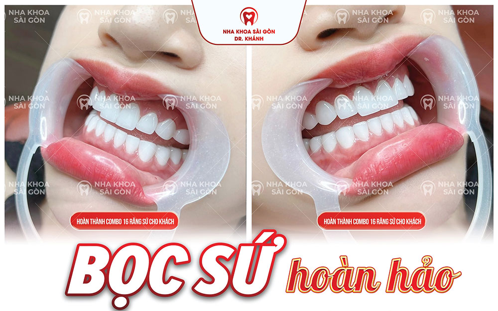 BỌC SỨ HOÀN HẢO - BẢO HÀNH LÊN ĐẾN 20 NĂM
