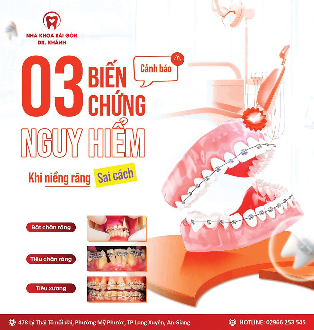 CẢNH BÁO 03 BIẾN CHỨNG NGUY HIỂM KHI NIỀNG RĂNG SAI CÁCH