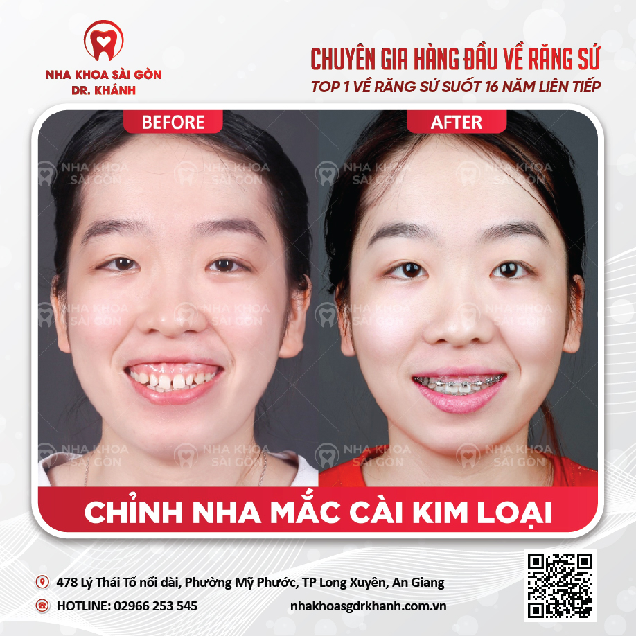 Niềng răng