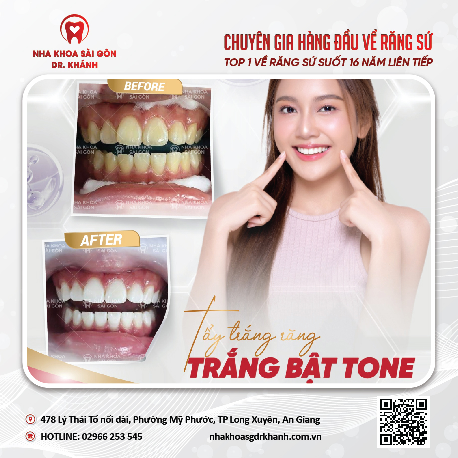 Tẩy trắng răng