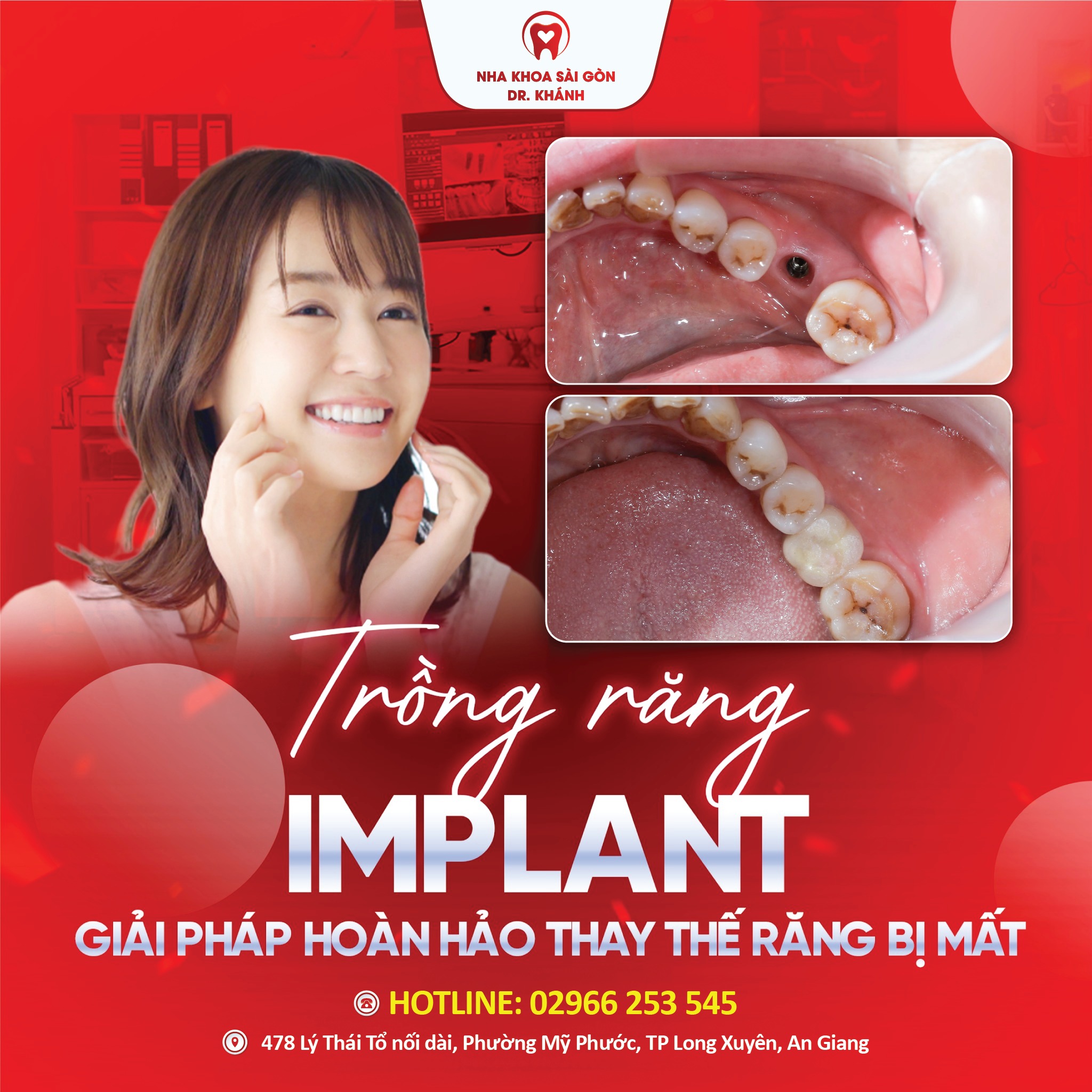 TRỒNG RĂNG IMPLANT - GIẢI PHÁP TỐI ƯU PHỤC HỒI RĂNG MẤT VĨNH VIỄN