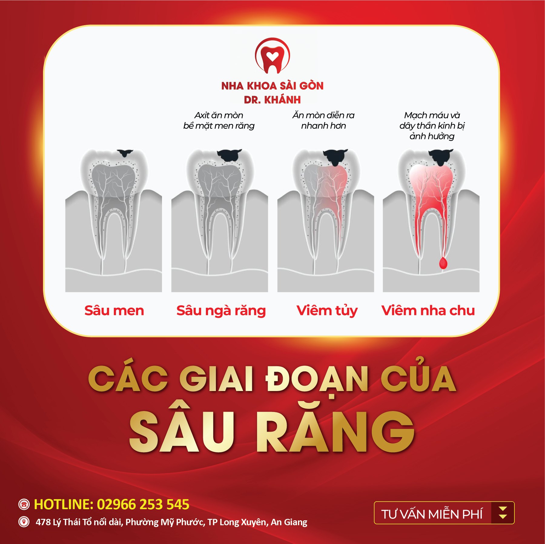 CÁC GIAI ĐOẠN HÌNH THÀNH SÂU RĂNG