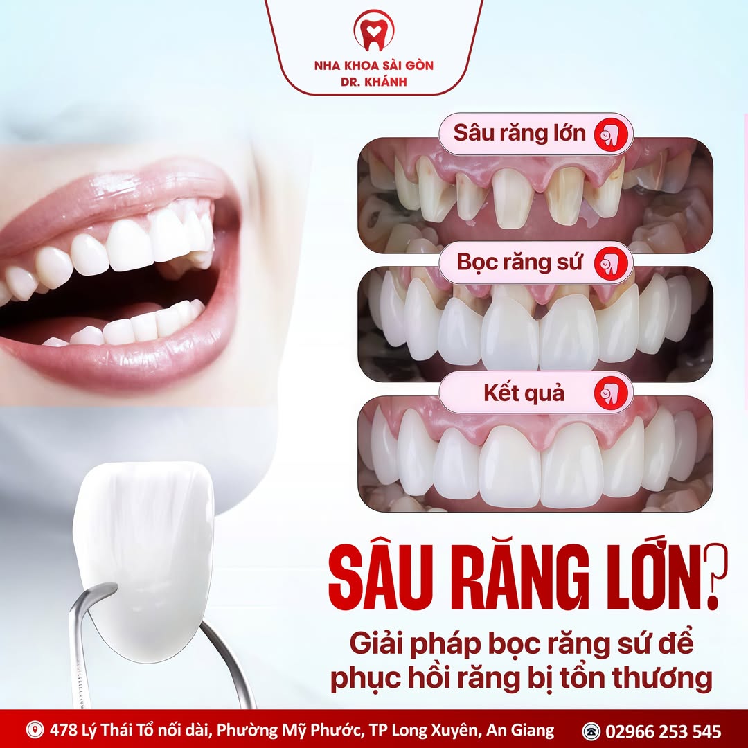 SÂU RĂNG LỚN - TRÁM KHÔNG NỔI - NHAI ĐAU BUỐT?
